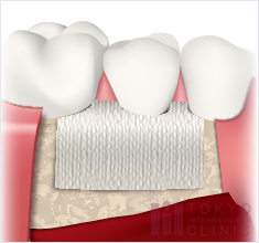 GTR(歯周組織誘導法)